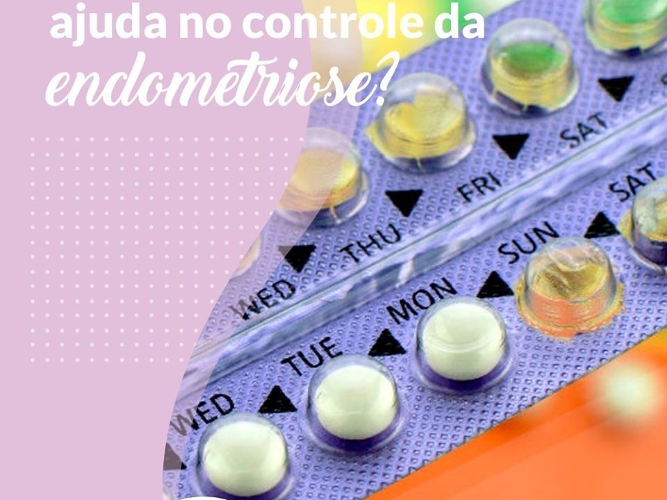 O anticoncepcional ajuda no controle da endometriose?