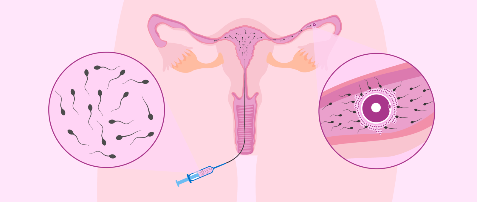 Inseminacao-Intrauterina7.png