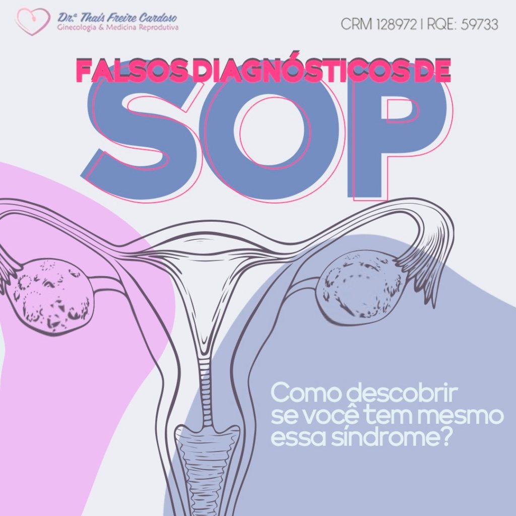 Falsos diagnósticos de SOP – Como descobrir se tem mesmo essa síndrome?